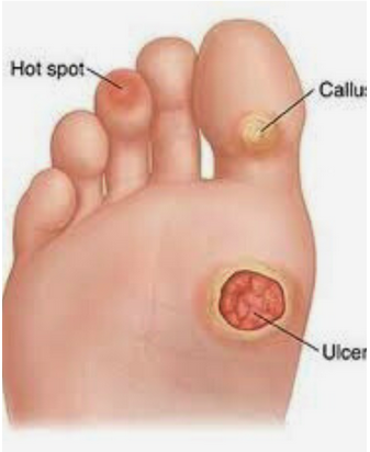 عوامل تزيد من خطر الإصابة بالقدم السكري 
